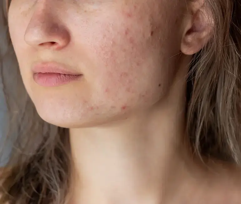 Close-up of a young woman's cheek and jaw showing red inflammatory acne marks and patches of leftover brown pigment